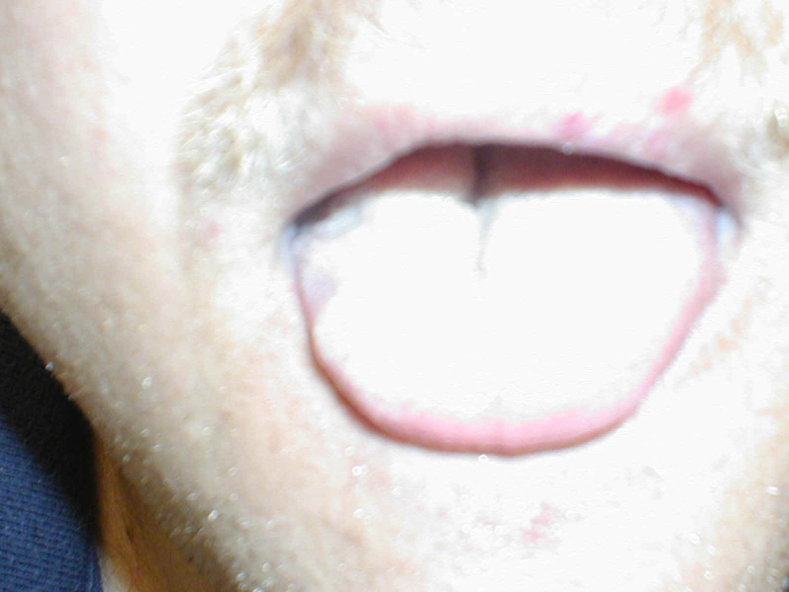 hypoglossalpalsy.jpg (82082 bytes)