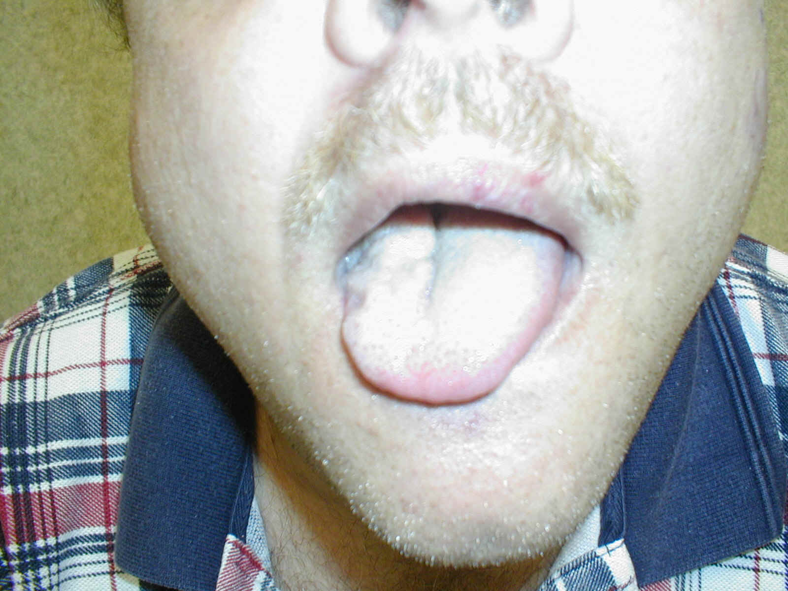hypoglossalpalsy1.jpg (150512 bytes)