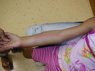 lymphangitis.jpg (125640 bytes)