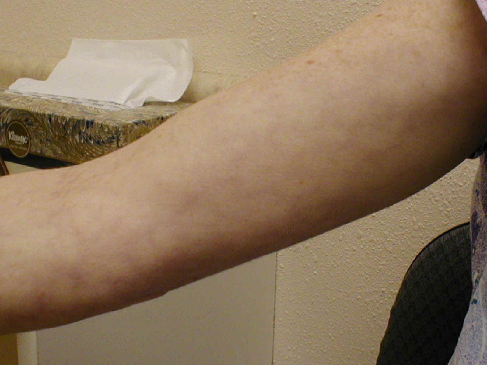 lymphangitis2.jpg (107571 bytes)