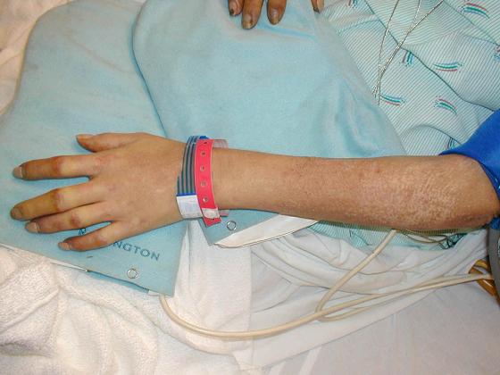 scleroderma.jpg (133457 bytes)