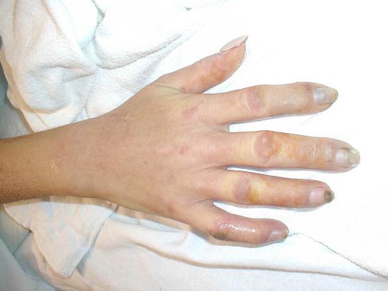 scleroderma1.jpg (101951 bytes)