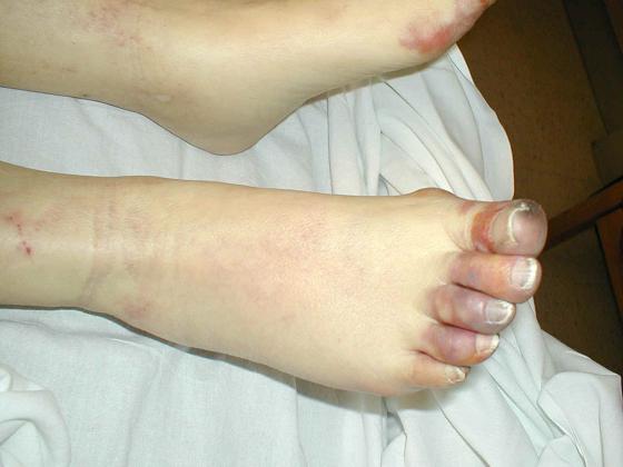 scleroderma2.jpg (99060 bytes)