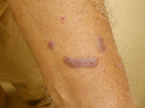 lichenplanus.jpg (99309 bytes)