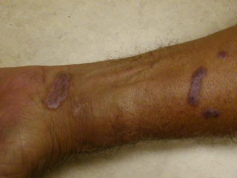 lichenplanus2.JPG (113881 bytes)